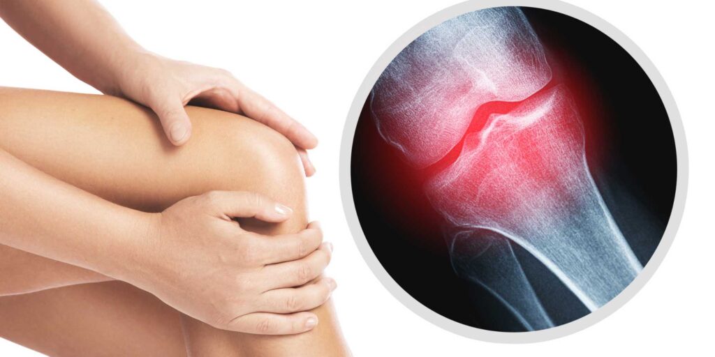 physical therapy for osteoarthritis